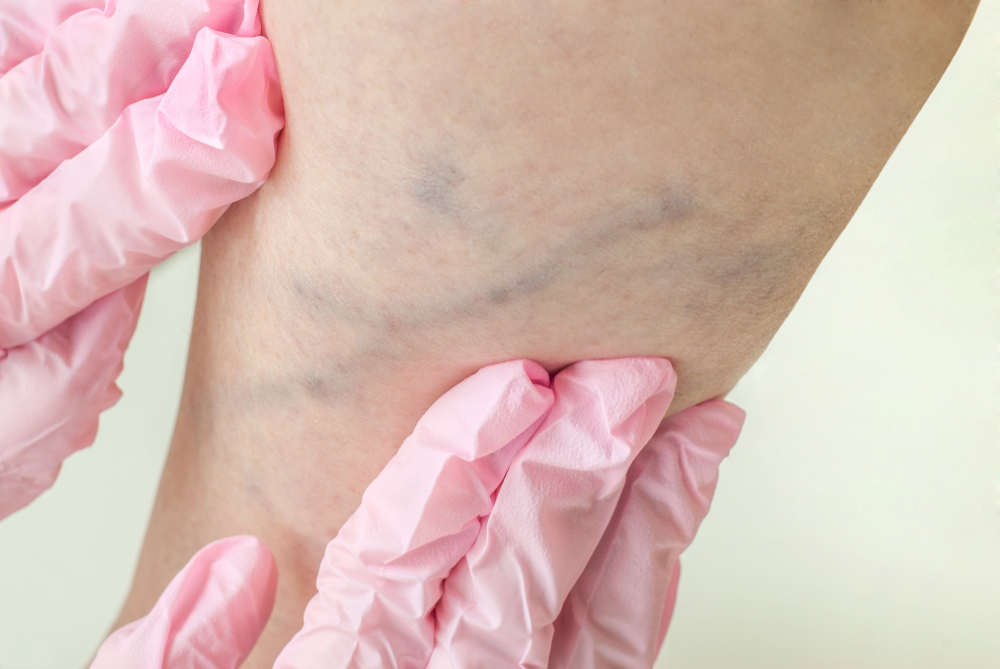 Das Bild zeigt Krampfadern an einem nackten Bein, die untersucht werden